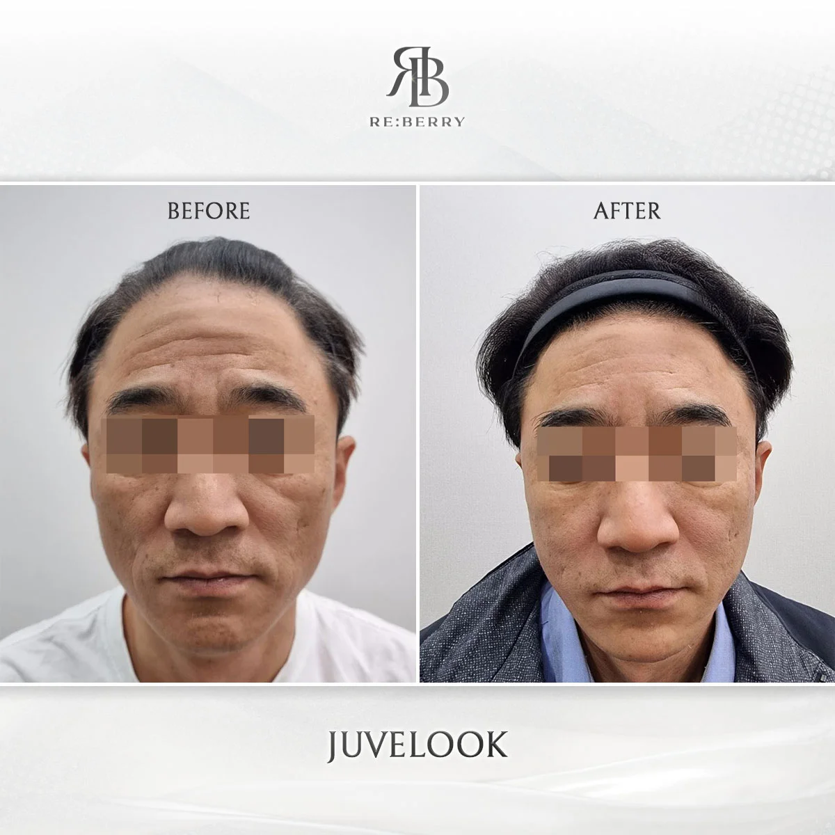 Juvelook Skin Booster